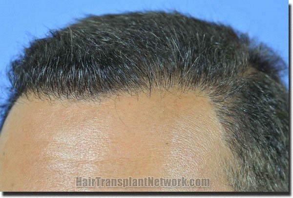 Hair restoration procedure results