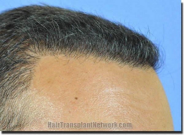 Hair restoration procedure results