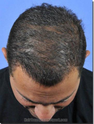 Hair restoration procedure results