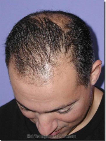 Hair restoration procedure results