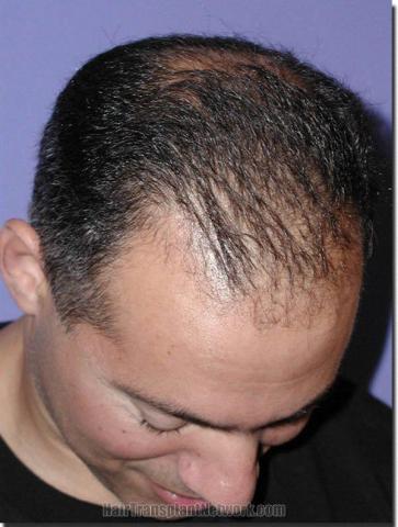 Hair restoration procedure results