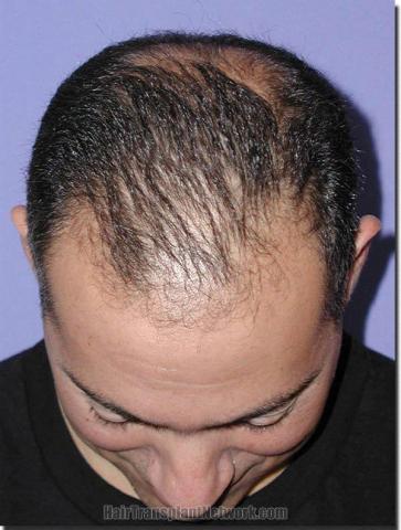 Hair restoration procedure results