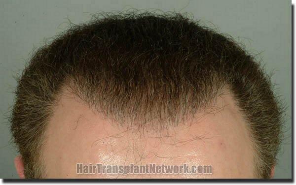 Hair restoration procedure results