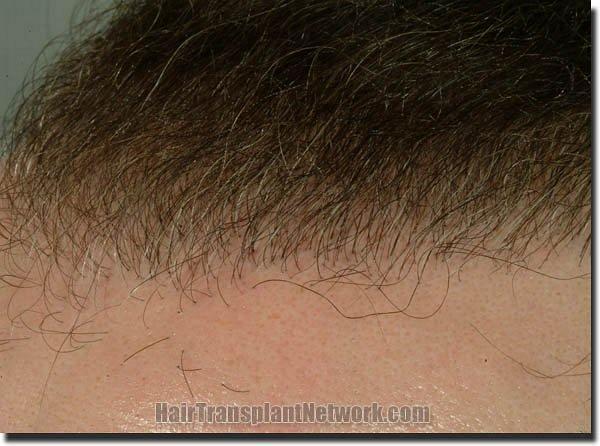 Hair restoration procedure results