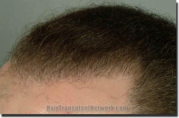 Hair restoration procedure results