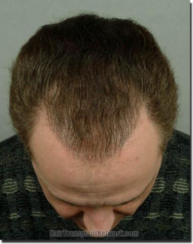 Hair restoration procedure results