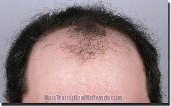 Hair restoration procedure results