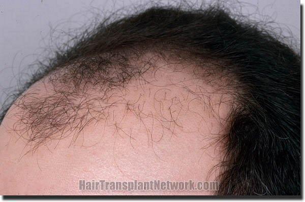 Hair restoration procedure results