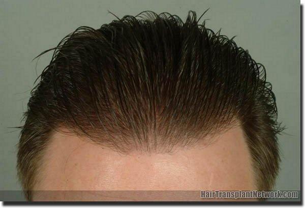 Hair restoration procedure results