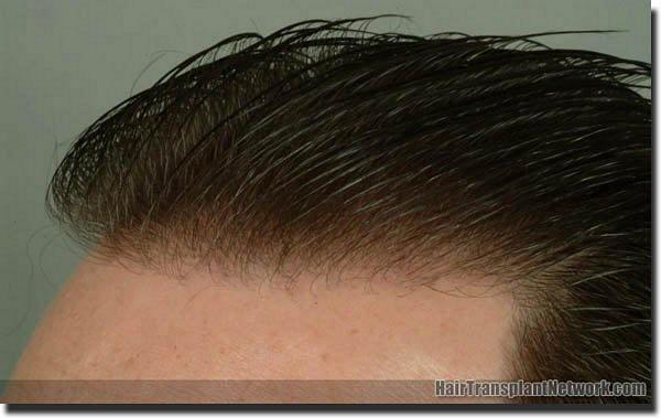 Hair restoration procedure results