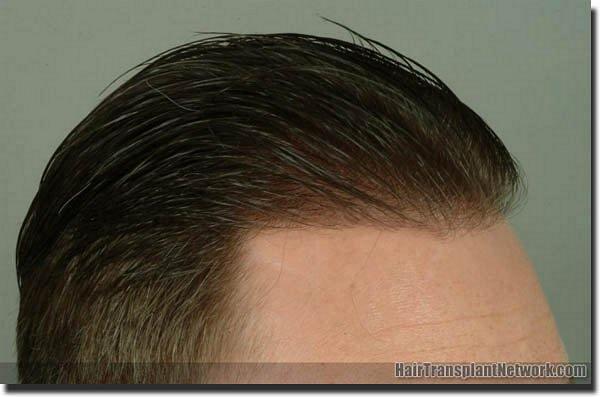 Hair restoration procedure results