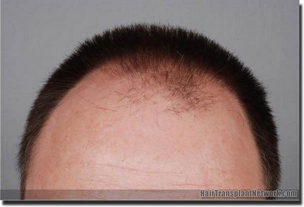 Hair restoration procedure results