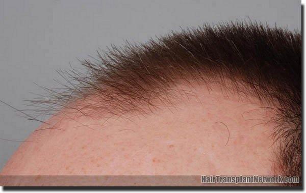 Hair restoration procedure results