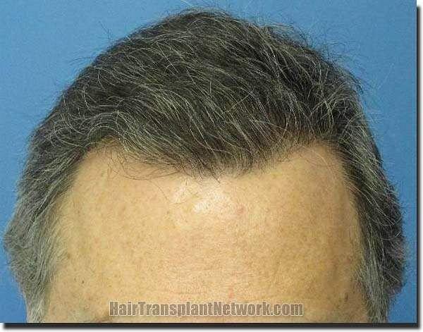 Hair restoration procedure results