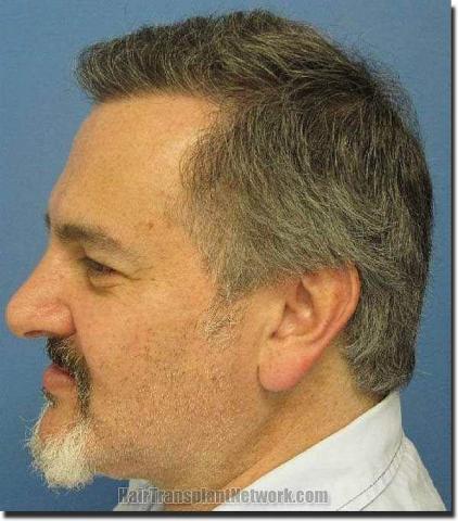 Hair restoration procedure results