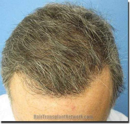 Hair restoration procedure results