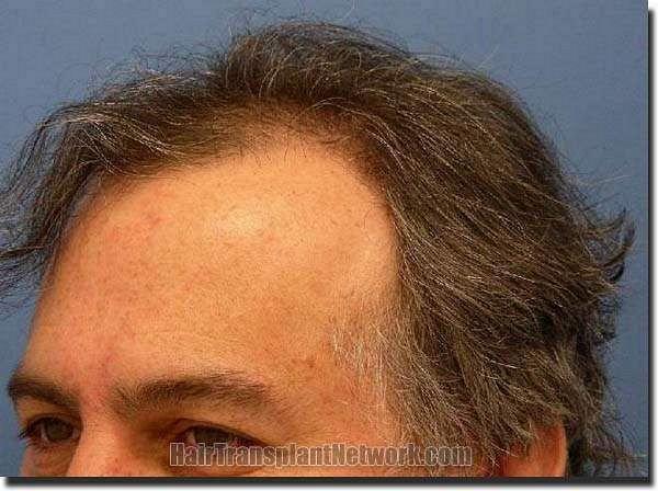 Hair restoration procedure results