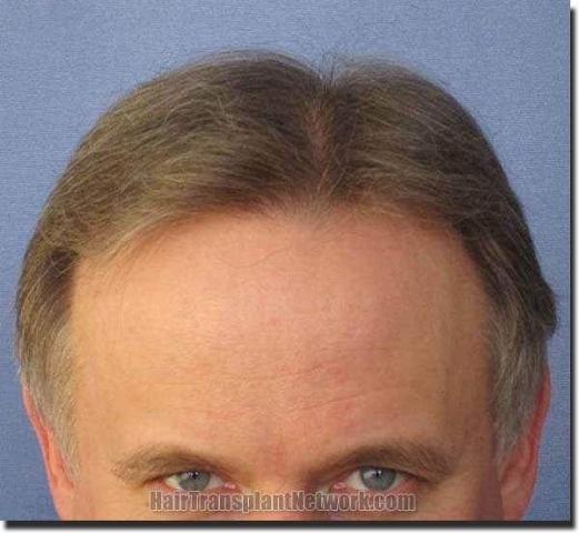 Hair restoration procedure results