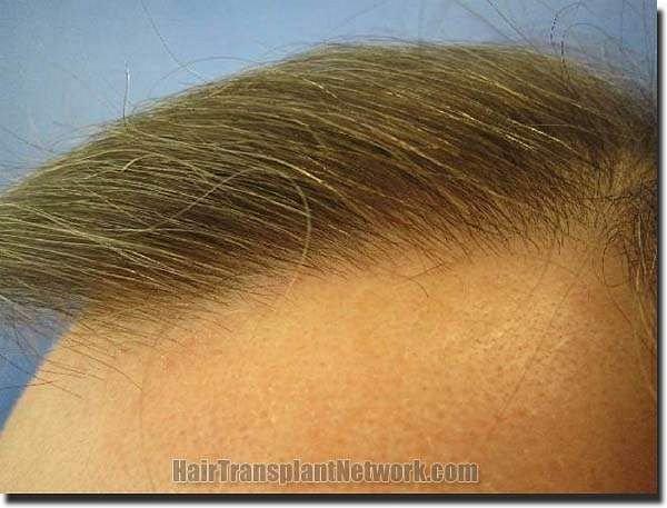 Hair restoration procedure results