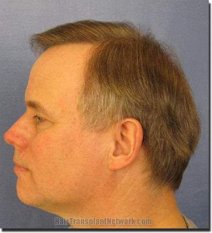 Hair restoration procedure results