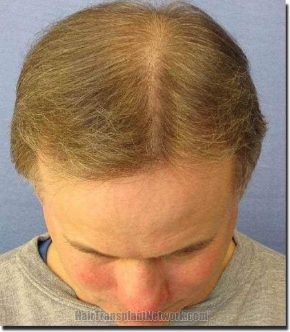 Hair restoration procedure results