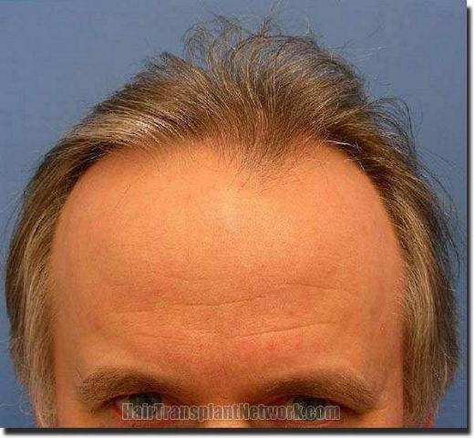 Hair restoration procedure results