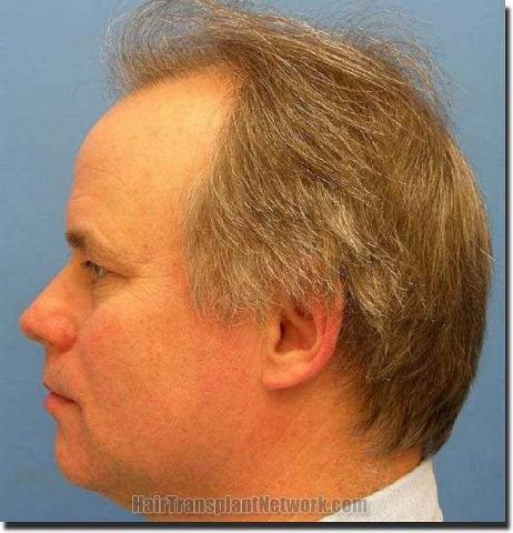 Hair restoration procedure results