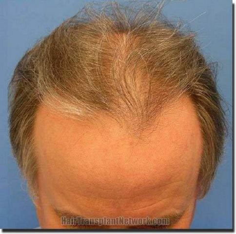 Hair restoration procedure results