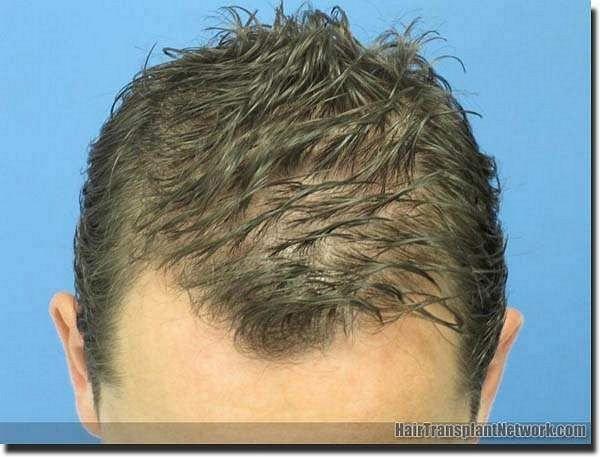 Hair restoration procedure results