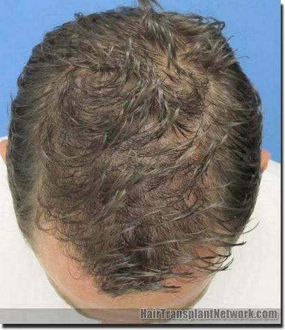 Hair restoration procedure results