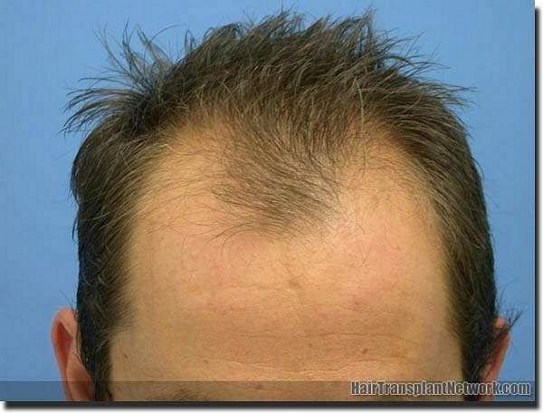 Hair restoration procedure results