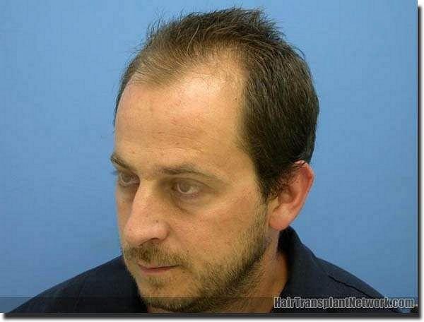 Hair restoration procedure results