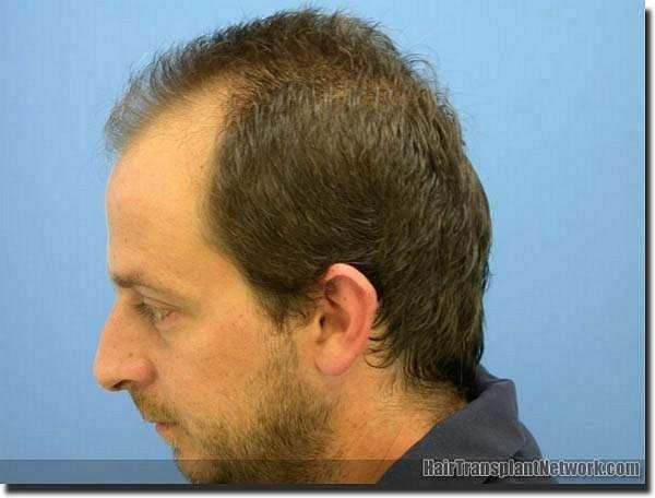 Hair restoration procedure results