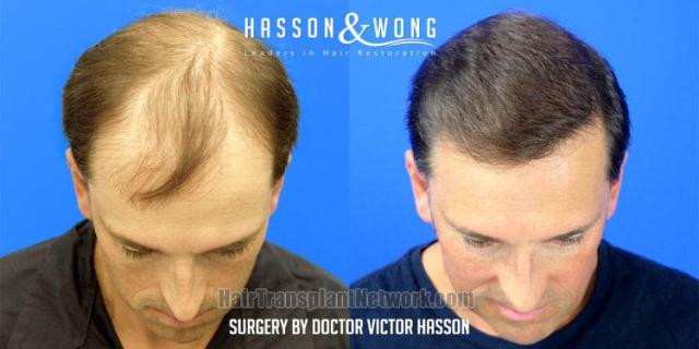 Before and after hair restoration procedure images