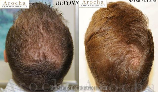 Hair restoration procedure before and after pictures