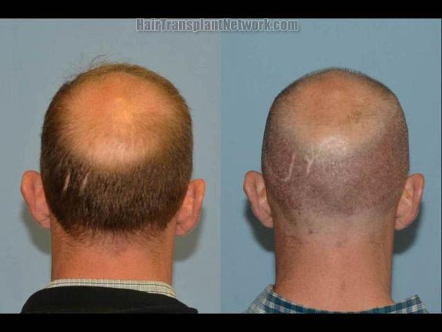 Hair restoration procedure before and after pictures