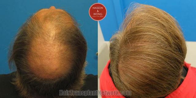 Hair restoration procedure before and after pictures