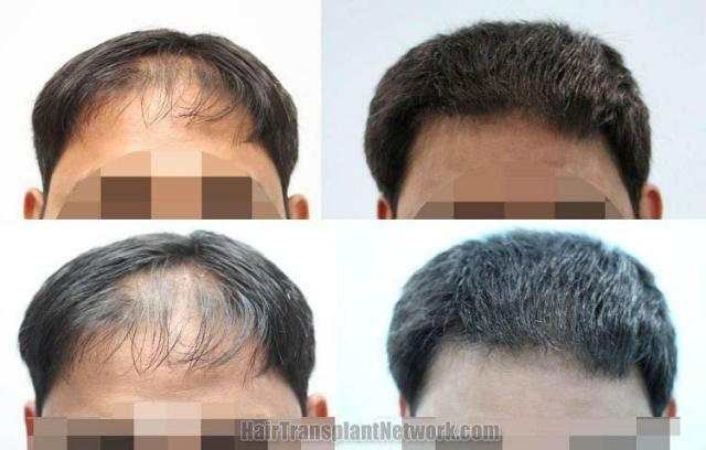 Hair transplantation surgery before and after photos