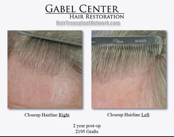 Hair transplant surgery before and after images