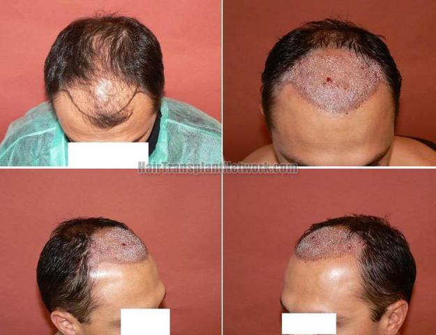 Hair transplantation surgery before and after pictures