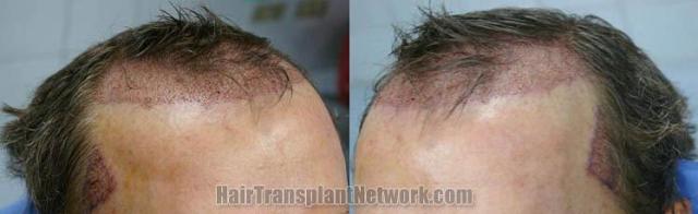 Hair restoration surgery before and after photos