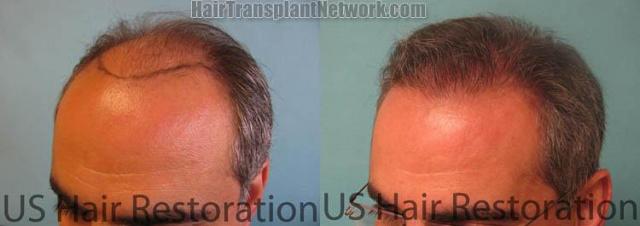 Hair transplantation surgery before and after photos