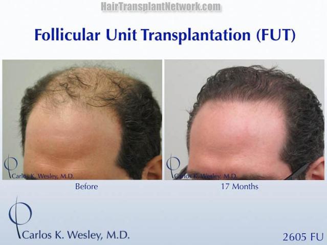 Hair transplantation surgery before and after images