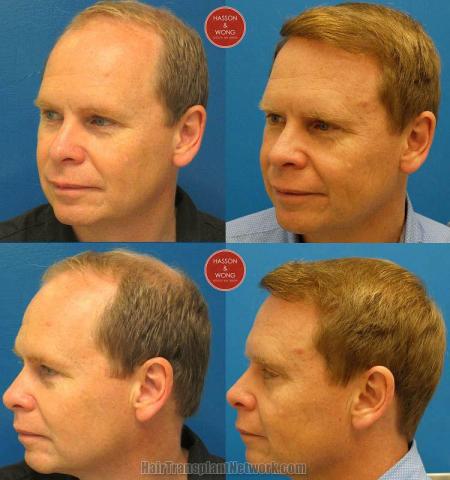 Hair transplant surgery before and after photos