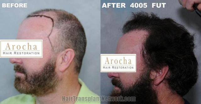 Hair transplantation surgery before and after pictures