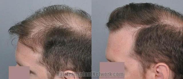 Hair restoration procedure before and after pictures