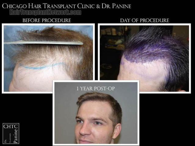 Hair transplantation surgery before and after pictures