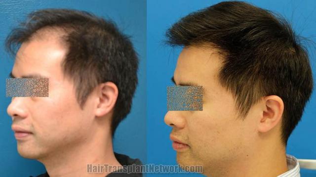 Hair transplantation surgery before and after images