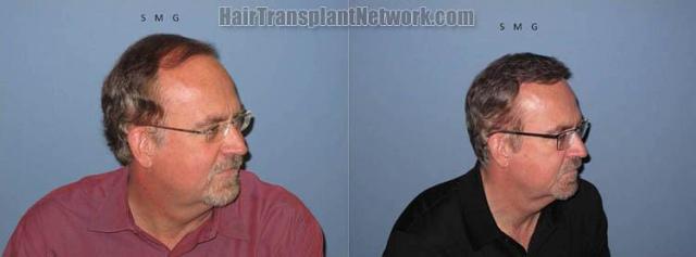 Right view before and after hair transplantation images