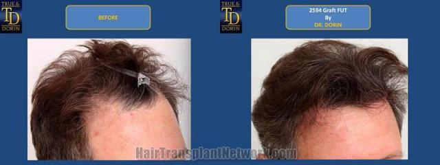 Hair transplantation surgery before and after images